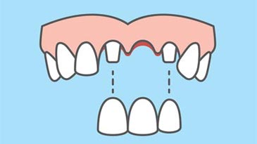 dental bridge for upper front tooth