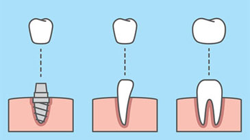 crown placed on implant, crown placed on existing tooth
