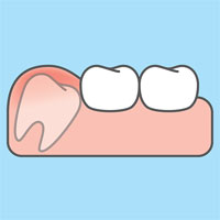 impacted wisdom tooth requiring extraction