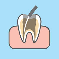 endodontic root canal treatment