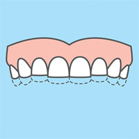 effects of bruxism, grinding teeth