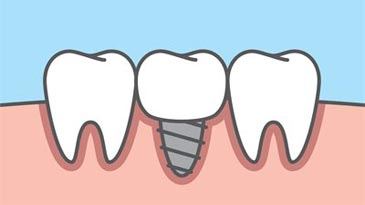 single dental implant in lower arch