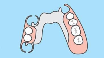 partial denture appliance
