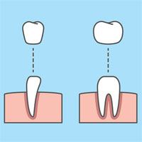 dental crown being placed on molar