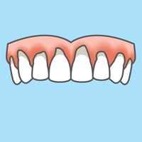 Illustration explaining healthy gums and gum inflammation