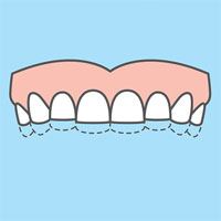Dental model used to evaluate clenching and grinding
